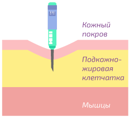 Игла 4–5–6 мм.Диабет, сахарный диабет, СД1 типа, СД 2 типа, Правило 15.