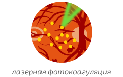 РЕТИНОПАТИЯ. Правило 15. Про диабет 1 и 2 типа